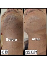 アールスサロン/メンズ髭脱毛