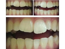 ボディケアアップ(BODY CARE UP↑)/イベント前に白い歯へ