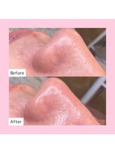 ホワイトラボ 梅田(White labo)/【施術例】ハイドロフェイシャル