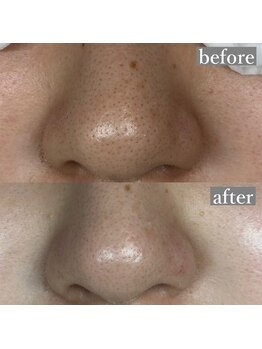 ライカブルー(RaicA BluE)/施術写真　before-after