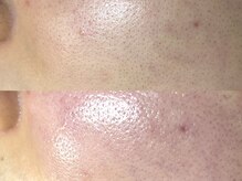 フレーズ(fraise)/毛穴エクストラクション