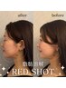 《脂肪分解痩身》韓国発RED SHOTで理想のフェイスライン♪60分