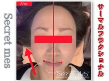 ルアナ(Luana)/サーマルフラクショナル