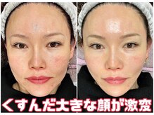 スペチアーレ 夙川/くすみも取れて美顔革命