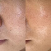 アトリーチェ ベレッツァ(ATTRICE Bellezza)