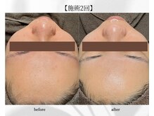 アン ビューティー(ann beauty)/施術2回【症例写真】20代