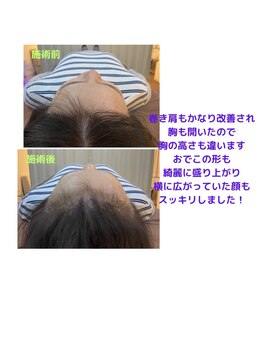 ミコット/筋膜アプローチの変化