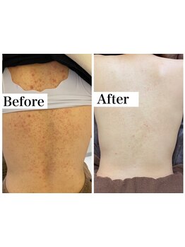 毛穴ケアをしたい