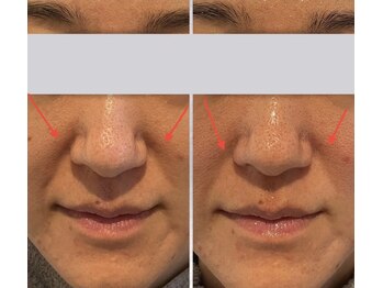 ビーメイクス(B・Makes)/プラズマフェイシャル