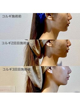 カルナ(CARNA)/フェイスライン上昇 美骨コルギ