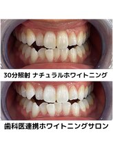 プラチナムビューティ 四条烏丸店(PLATINUM Beauty)/ホワイトニングビフォーアフター