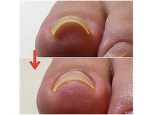 巻爪ケアもご用意しております。お悩みお気軽にご相談下さい。