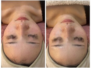 シャイネル(SHYNELL)/アンストレス1回のお写真です!