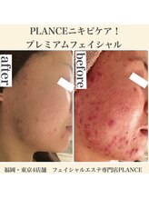プランス 渋谷(PLANCE)/ニキビケア　渋谷