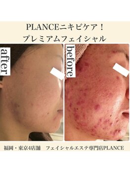 プランス 渋谷(PLANCE)/ニキビケア 渋谷