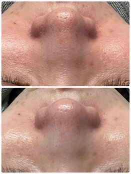 ティアーナ(Tiaana)/毛穴洗浄