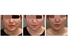 ウォーマル(warmaL)/小顔矯正/間が空いても大丈夫！