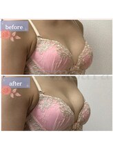 サムサラ(SamSara)/BeforeAfter/バストボリューム