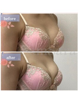 サムサラ(SamSara)/BeforeAfter/バストボリューム