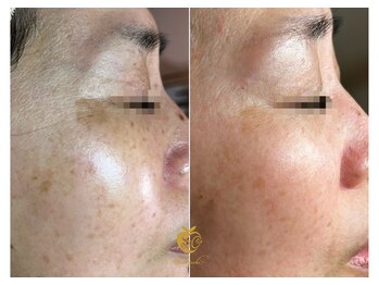 しらゆき 名古屋黒川/シミケア