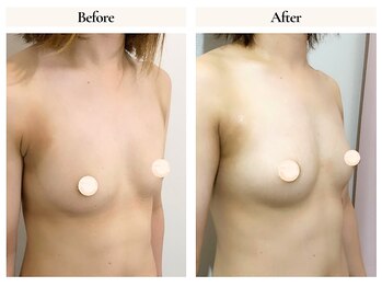 サロンドローヴ(Salon de LOAVE)/バストアップ症例