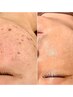 【メニューにお悩みの方に☆】カウンセリング後、メニューを決め施術