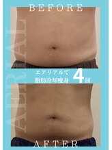 エアリアル 中津店/男性の脂肪冷却！ビール腹改善！