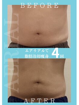 エアリアル 中津店/男性の脂肪冷却!ビール腹改善!