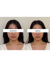 ヘルシールーム 六本木7丁目店(Healthy room)/before/after【浮腫み/小顔】