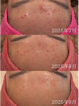 マハロプラス 宮崎本店(Mahalo+)/セルマン/肌改善・ピーリング