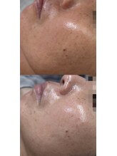 ココリール/乾燥肌・赤み