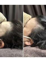 セントラル鍼灸院リラクシー(Re:laxy)&nbsp;育毛 促進鍼