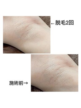 エミナル(EMINAL)/~脇脱毛の効果~女性