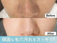 デジール/【メンズハイドロ毛穴洗浄吸引】