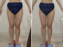 カプリス(CAPRiCE)/リンパドレナージュ