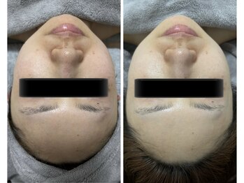 ラン(Ran)/コルギAfter写真