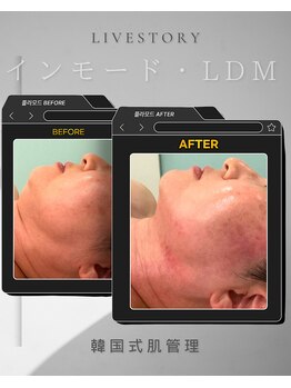 ライブ ストーリー(Live story)/小顔、たるみケア