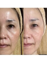 ビアージュ(美age)/ビフォーアフター