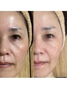 ビアージュ(美age)/ビフォーアフター