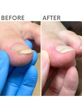 クオッカ(Quokka)/巻き爪ケア