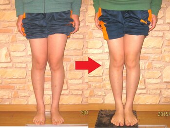 チャラク(charaku)/【30代T様：X脚矯正・骨盤矯正】