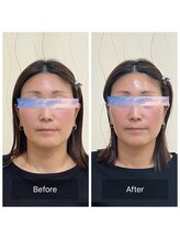 ハリ トモカ 南浦和サロン(HARI TOMOKA)/美容鍼