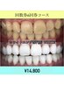 【回数券6回券】セルフホワイトニング  ¥24,800 → ¥16,000