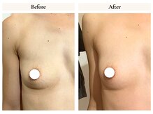 サロンドローヴ(Salon de LOAVE)/バストアップ症例