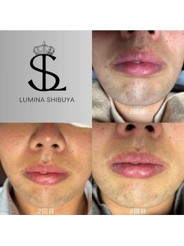 ルミナ シブヤ(LUMINA SHIBUYA)/脱毛1～3回目
