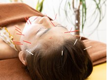 はな鍼灸院/頭皮の鍼から全身