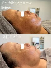 ルノン(Lunon)/毛穴洗浄ハイドロ×ララピール