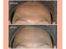 ベルミーランド 浜松天王/フェイシャルBefore→After