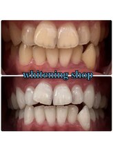 ホワイトニングショップ 和歌山店/Before&After美白ホワイトニング