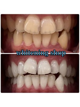 ホワイトニングショップ 和歌山店/Before&After美白ホワイトニング
